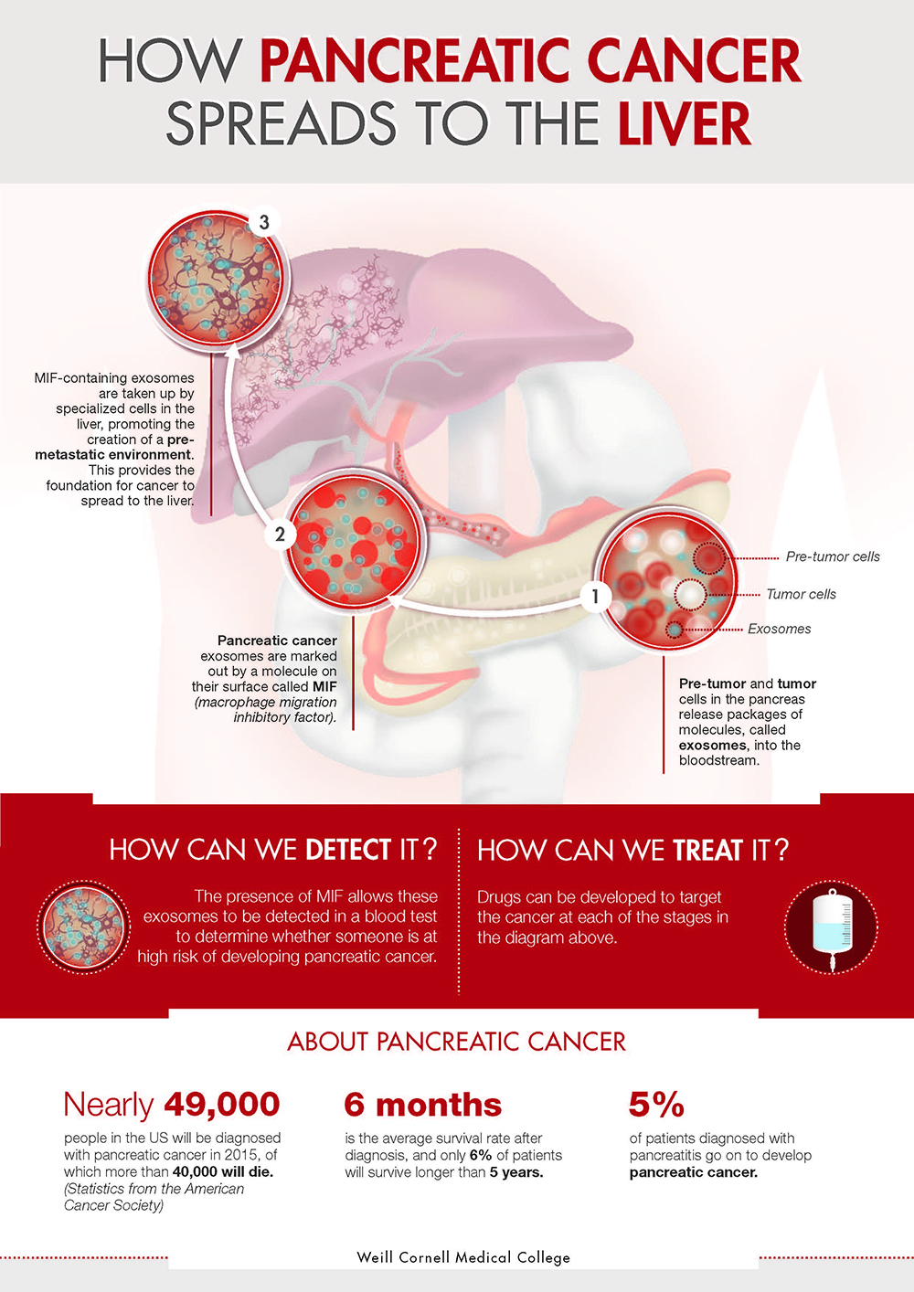 Uno Studio Scopre Come Il Cancro Del Pancreas Si Diffonde Al