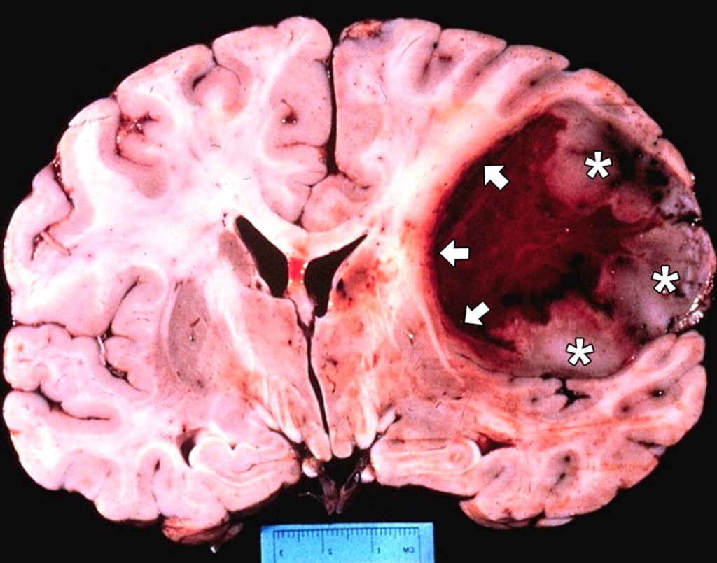 Glioblastoma Prima Biostampa 3D Dell intero Tumore Attivo MediMagazine