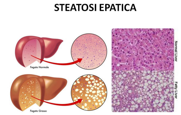 Zucchero Naturale Può Trattare La Steatosi Epatica Non Alcolica