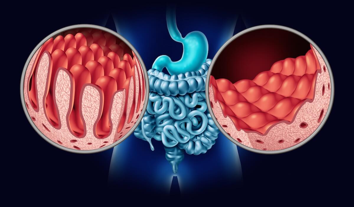 Scoperto un fungo che favorisce lo sviluppo della malattia di Crohn