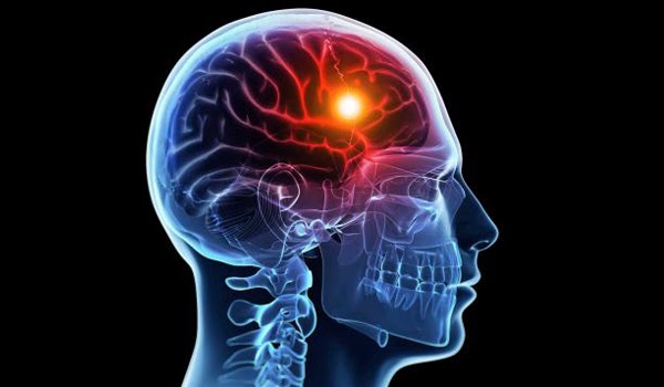 Stroke 2019 Ultime Scoperte Della Ricerca Sullictus