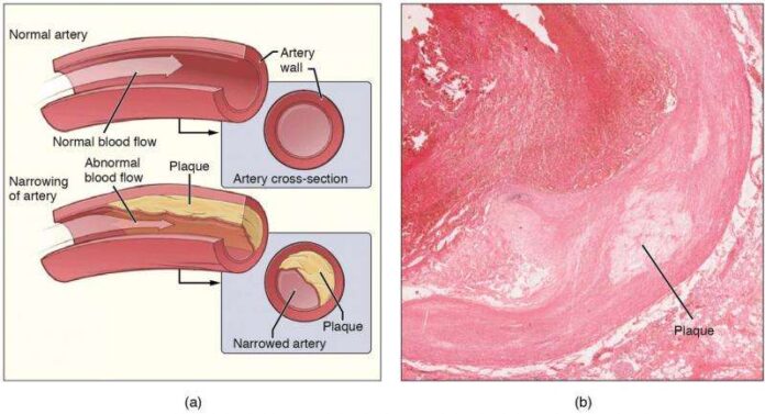 aterosclerosi-una-proteina-la-causa-dell-infiammazione-medimagazine