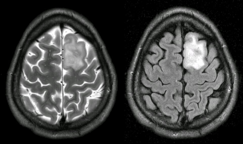 brain-tumor-types-glioblastoma-meningioma-more