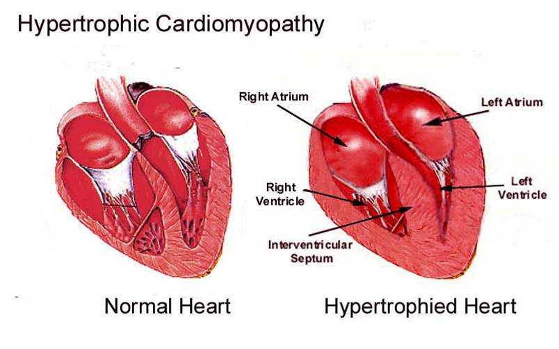 cardiomiopatia-ipertrofica-nuova-comprensione-medimagazine